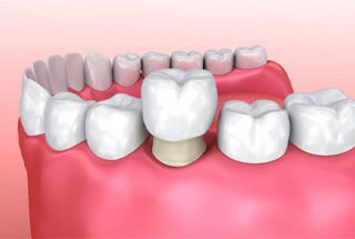 Illustration of a dental crown in McKinney