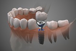 Animated model of dental implant with dental crown in lower jaw