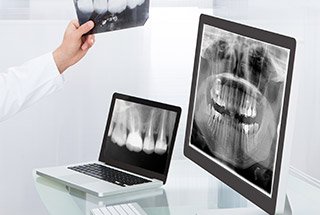 Digital dental x rays on computers