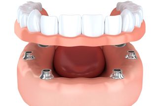 Animated model of All on 4 dental implants