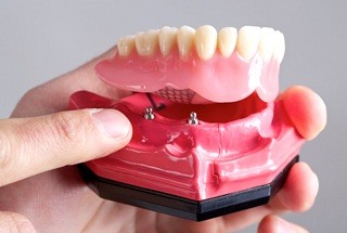 Hand holding an implant denture model