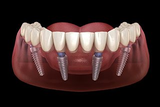 Close up of All on 4 implant dentures for the lower arch