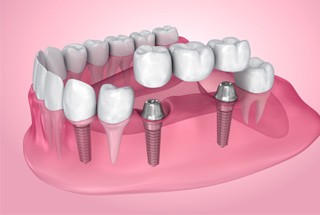 closeup of an implant bridge in McKinney