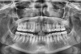 Highly detailed panoramic C B C T image of patient’s teeth
