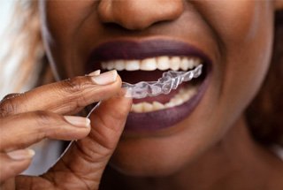 Woman placing clear aligners on top teeth