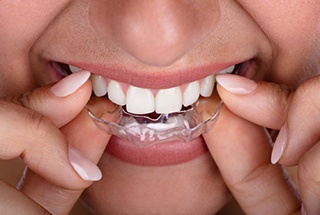 A person inserting a ClearCorrect aligner in the top arch of their mouth