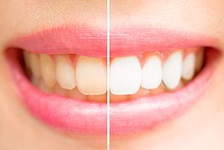 Closeup of smile half before and half after whitening