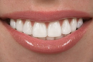 Close up of pearly white smile after crown lengthening in McKinney