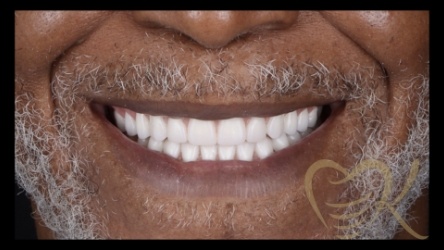 Close up of smile after denture