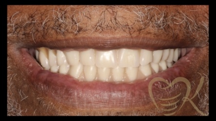 Close up of smile before denture