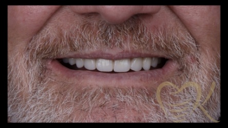 Close up of smile before denture