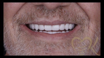 Close up of smile after denture