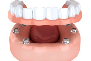 example of implant dentures representing cost of dentures in McKinney