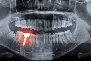 X-ray of failed dental implant in McKinney