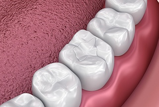 A 3D close-up of tooth-colored fillings in McKinney
