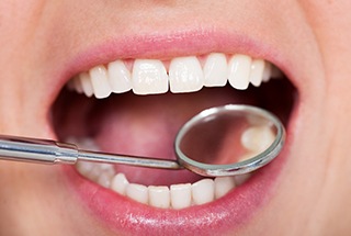 A close up of a mouth with tooth colored fillings in McKinney