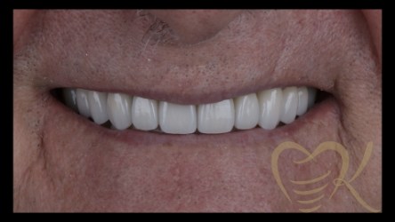 Close up of smile after full mouth reconstruction
