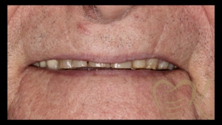 Close up of smile before full mouth reconstruction