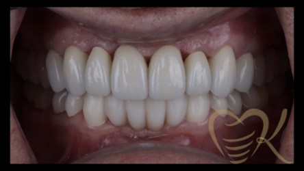 Close up of smile after full mouth reconstruction