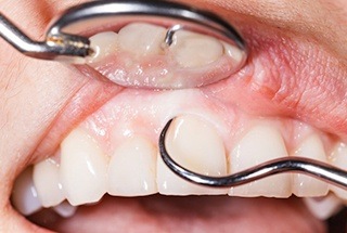 Close up of mouth receiving gum disease treatment in McKinney