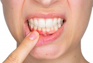Person pointing to their inflamed gums