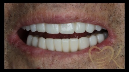 Close up of smile after hybrid denture