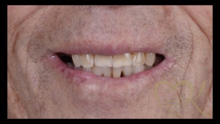 Close up of smile before hybrid denture