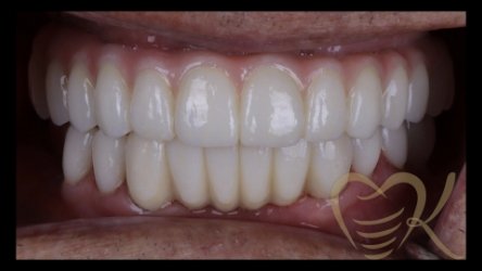 Close up of smile after hybrid denture