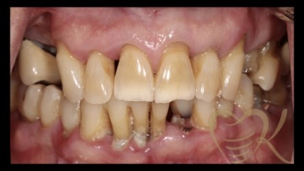 Close up of smile before hybrid denture