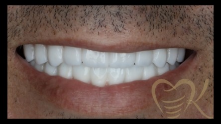 Close up of smile after hybrid denture