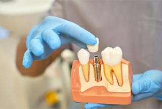 dentist placing a crown on a model of a dental implant in McKinney