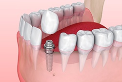 Digital illustration of a single tooth dental implant in McKinney 
