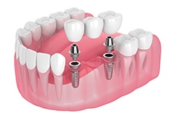 Digital illustration of implant bridge replacing multiple missing teeth in McKinney