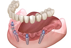 Digital illustration of how implant dentures in McKinney work