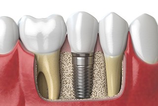 Diagram of dental implants in McKinney