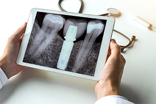 X ray after advanced dental implant procedure in McKinney