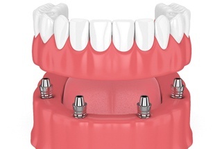 model of implant dentures in McKinney