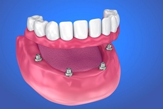 Model of implant denture