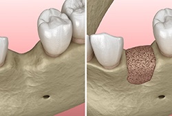 Diagram of a bone graft in McKinney for dental implants 