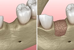 Diagram of a bone graft in McKinney for dental implants