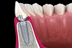 Digital illustration of a ridge expansion in McKinney for dental implants