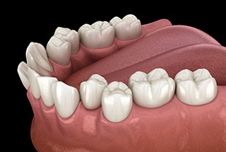 Digital image of crowded teeth