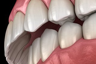 Digital image of an overbite