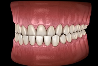 Digital image of an underbite