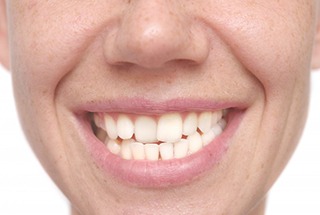 Person with a crossbite that includes overlapping teeth