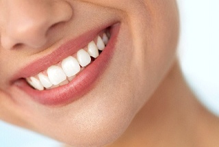 Closeup of woman's bright beautiful smile with Lumineers in McKinney