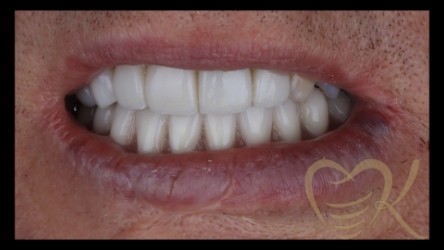 Close up of smile after maxillofacial surgery