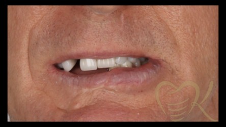 Close up of smile before maxillofacial surgery