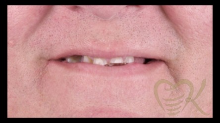 Close up of smile before overdenture