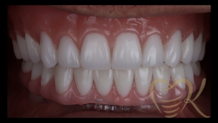 Close up of smile after getting overdenture